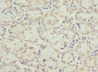 Immunohistochemistry of paraffin-embedded human gastric cancer using VANGL2 Antibody at dilution of 1:100Rabbit anti-Human VANGL2 Polyclonal Antibody