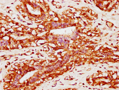IHC image of the antibody diluted at 1:400 and staining in paraffin-embedded human breast cancer performed on a Leica BondTM system. After dewaxing and hydration, antigen retrieval was mediated by high pressure in a citrate buffer (pH 6.0). Section was blocked with 10% normal goat serum 30min at RT. Then primary antibody (1% BSA) was incubated at 4°C overnight. The primary is detected by a biotinylated secondary antibody and visualized using an HRP conjugated SP system.Rabbit anti-Human PACSIN2 Polyclonal Antibody