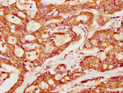 IHC image of PACSIN2 Antibody diluted at 1:400 and staining in paraffin-embedded human colon cancer performed on a Leica BondTM system. After dewaxing and hydration, antigen retrieval was mediated by high pressure in a citrate buffer (pH 6.0). Section was blocked with 10% normal goat serum 30min at RT. Then primary antibody (1% BSA) was incubated at 4°C overnight. The primary is detected by a biotinylated secondary antibody and visualized using an HRP conjugated SP system.Rabbit anti-Human PACSIN2 Polyclonal Antibody