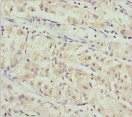 Immunohistochemistry of paraffin-embedded human gastric cancer using PACSIN2 Antibody at dilution of 1:100Rabbit anti-Human PACSIN2 Polyclonal Antibody