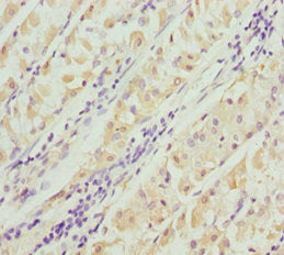 Immunohistochemistry of paraffin-embedded human gastric cancer using PACSIN2 Antibody at dilution of 1:100Rabbit anti-Human PACSIN2 Polyclonal Antibody