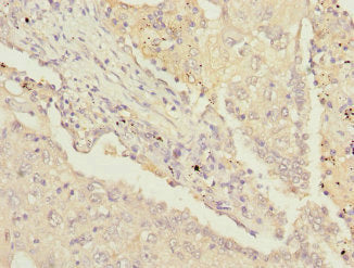 Immunohistochemistry of paraffin-embedded human lung cancer using PSMD13 Antibody at dilution of 1:100Rabbit anti-Human PSMD13 Polyclonal Antibody