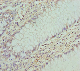 Immunohistochemistry of paraffin-embedded human colon cancer using COG5 Antibody at dilution of 1:100Rabbit anti-Human COG5 Polyclonal Antibody
