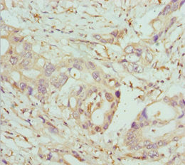Immunohistochemistry of paraffin-embedded human pancreatic cancer using COG5 Antibody at dilution of 1:100Rabbit anti-Human COG5 Polyclonal Antibody