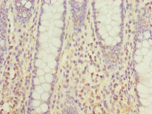 Immunohistochemistry of paraffin-embedded human colon cancer using DHDH Antibody at dilution of 1:100Rabbit anti-Human DHDH Polyclonal Antibody