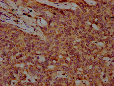 IHC image of the antibody diluted at 1:500 and staining in paraffin-embedded human liver cancer performed on a Leica BondTM system. After dewaxing and hydration, antigen retrieval was mediated by high pressure in a citrate buffer (pH 6.0). Section was blocked with 10% normal goat serum 30min at RT. Then primary antibody (1% BSA) was incubated at 4°C overnight. The primary is detected by a biotinylated secondary antibody and visualized using an HRP conjugated SP system.Rabbit anti-Human FBXO10 Polyclonal Antibody