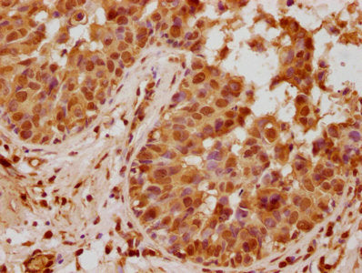 IHC image of PYCARD Antibody diluted at 1:740 and staining in paraffin-embedded human breast cancer performed on a Leica BondTM system. After dewaxing and hydration, antigen retrieval was mediated by high pressure in a citrate buffer (pH 6.0). Section was blocked with 10% normal goat serum 30min at RT. Then primary antibody (1% BSA) was incubated at 4°C overnight. The primary is detected by a biotinylated secondary antibody and visualized using an HRP conjugated SP system.Rabbit anti-Human PYCARD Polyclonal Antibody