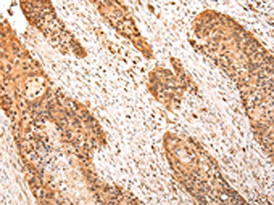 The image on the left is immunohistochemistry of paraffin-embedded Human esophagus cancer tissue using ZPR1 Antibody(ZPR1 Antibody) at dilution 1/20, on the right is treated with synthetic peptide. (Original magnification: ×200)Rabbit anti-Human ZPR1 Polyclonal Antibody