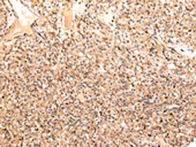 The image on the left is immunohistochemistry of paraffin-embedded Human prostate cancer tissue using the antibody Antibody) at dilution 1/20, on the right is treated with synthetic peptide. (Original magnification: ×200)Rabbit anti-Human ZPR1 Polyclonal Antibody