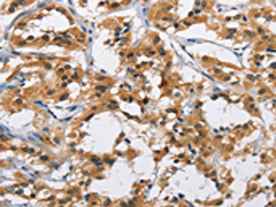 The image on the left is immunohistochemistry of paraffin-embedded Human thyroid cancer tissue using CYP21A2 Antibody(CYP21A2 Antibody) at dilution 1/60, on the right is treated with fusion protein. (Original magnification: ×200)Rabbit anti-Human CYP21A2 Polyclonal Antibody