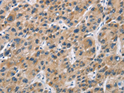 The image on the left is immunohistochemistry of paraffin-embedded Human liver cancer tissue using the antibody Antibody) at dilution 1/60, on the right is treated with fusion protein. (Original magnification: ×200)Rabbit anti-Human CYP21A2 Polyclonal Antibody