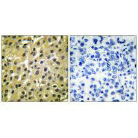 Immunohistochemical analysis of paraffin-embedded human breast carcinoma tissue using MDM2 antibody.