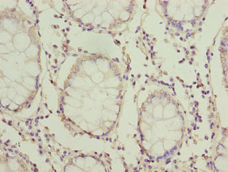 Immunohistochemistry of paraffin-embedded human colon cancer using HOOK1 Antibody at dilution of 1:100Rabbit anti-Human HOOK1 Polyclonal Antibody
