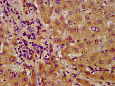 IHC image of the antibody diluted at 1:600 and staining in paraffin-embedded human liver tissue performed on a Leica BondTM system. After dewaxing and hydration, antigen retrieval was mediated by high pressure in a citrate buffer (pH 6.0). Section was blocked with 10% normal goat serum 30min at RT. Then primary antibody (1% BSA) was incubated at 4°C overnight. The primary is detected by a biotinylated secondary antibody and visualized using an HRP conjugated SP system.Rabbit anti-Human NUDT5 Polyclonal Antibody