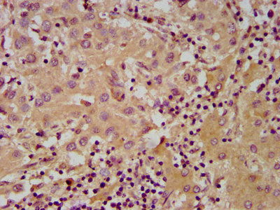 IHC image of NUDT5 Antibody diluted at 1:600 and staining in paraffin-embedded human liver cancer performed on a Leica BondTM system. After dewaxing and hydration, antigen retrieval was mediated by high pressure in a citrate buffer (pH 6.0). Section was blocked with 10% normal goat serum 30min at RT. Then primary antibody (1% BSA) was incubated at 4°C overnight. The primary is detected by a biotinylated secondary antibody and visualized using an HRP conjugated SP system.Rabbit anti-Human NUDT5 Polyclonal Antibody