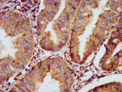 IHC image of GJD2 Antibody diluted at 1:500 and staining in paraffin-embedded human endometrial cancer performed on a Leica BondTM system. After dewaxing and hydration, antigen retrieval was mediated by high pressure in a citrate buffer (pH 6.0). Section was blocked with 10% normal goat serum 30min at RT. Then primary antibody (1% BSA) was incubated at 4°C overnight. The primary is detected by a biotinylated secondary antibody and visualized using an HRP conjugated SP system.Rabbit anti-Human GJD2 Polyclonal Antibody