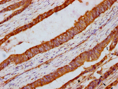 IHC image of the antibody diluted at 1:300 and staining in paraffin-embedded human colon cancer performed on a Leica BondTM system. After dewaxing and hydration, antigen retrieval was mediated by high pressure in a citrate buffer (pH 6.0). Section was blocked with 10% normal goat serum 30min at RT. Then primary antibody (1% BSA) was incubated at 4°C overnight. The primary is detected by a biotinylated secondary antibody and visualized using an HRP conjugated SP system.