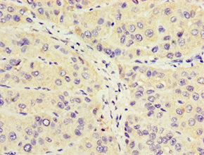 Immunohistochemistry of paraffin-embedded human liver cancer using CROT Antibody at dilution of 1:100Rabbit anti-Human CROT Polyclonal Antibody