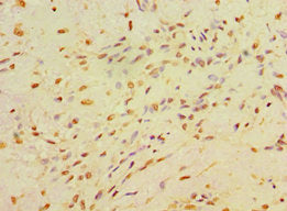 Immunohistochemistry of paraffin-embedded human breast cancer using CA14 Antibody at dilution of 1:100