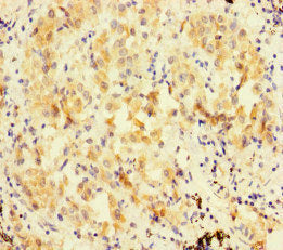 Immunohistochemistry of paraffin-embedded human lung cancer using FBXL21 Antibody at dilution of 1:100Rabbit anti-Human FBXL21 Polyclonal Antibody