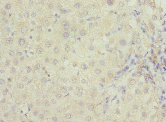 Immunohistochemistry of paraffin-embedded human liver cancer using RAB23 Antibody at dilution of 1:100Rabbit anti-Human RAB23 Polyclonal Antibody
