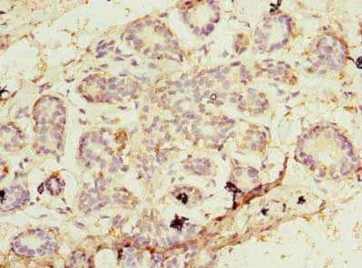 Immunohistochemistry of paraffin-embedded human breast cancer using PA2G4 Antibody at dilution of 1:100Rabbit anti-Human PA2G4 Polyclonal Antibody