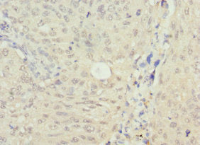Immunohistochemistry of paraffin-embedded human lung cancer using NSFL1C Antibody at dilution of 1:100Rabbit anti-Human NSFL1C Polyclonal Antibody