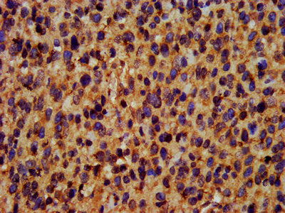 IHC image of the antibody diluted at 1:400 and staining in paraffin-embedded human glioma performed on a Leica BondTM system. After dewaxing and hydration, antigen retrieval was mediated by high pressure in a citrate buffer (pH 6.0). Section was blocked with 10% normal goat serum 30min at RT. Then primary antibody (1% BSA) was incubated at 4°C overnight. The primary is detected by a biotinylated secondary antibody and visualized using an HRP conjugated SP system.Rabbit anti-Human TRIM35 Polyclonal Antibody