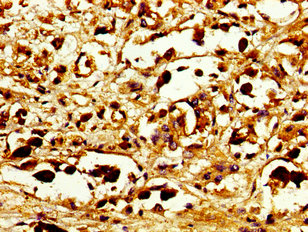 Immunohistochemistry of paraffin-embedded human melanoma using the antibody at dilution of 1: 100Rabbit anti-Human CD207 Polyclonal Antibody