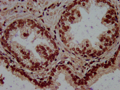 IHC image of RALY Antibody diluted at 1:500 and staining in paraffin-embedded human prostate cancer performed on a Leica BondTM system. After dewaxing and hydration, antigen retrieval was mediated by high pressure in a citrate buffer (pH 6.0). Section was blocked with 10% normal goat serum 30min at RT. Then primary antibody (1% BSA) was incubated at 4°C overnight. The primary is detected by a biotinylated secondary antibody and visualized using an HRP conjugated SP system.Rabbit anti-Human RALY Polyclonal Antibody