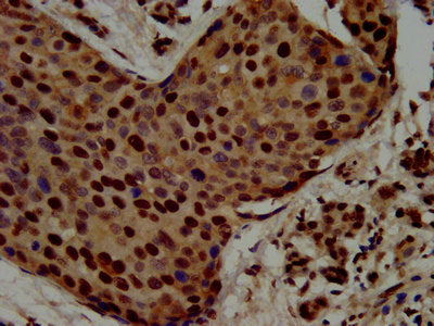 IHC image of RALY Antibody diluted at 1:500 and staining in paraffin-embedded human pancreatic cancer performed on a Leica BondTM system. After dewaxing and hydration, antigen retrieval was mediated by high pressure in a citrate buffer (pH 6.0). Section was blocked with 10% normal goat serum 30min at RT. Then primary antibody (1% BSA) was incubated at 4°C overnight. The primary is detected by a biotinylated secondary antibody and visualized using an HRP conjugated SP system.Rabbit anti-Human RALY Polyclonal Antibody