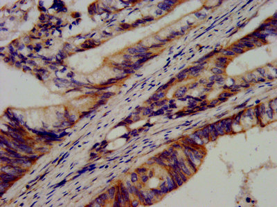 IHC image of CDH9 Antibody diluted at 1:600 and staining in paraffin-embedded human colon cancer performed on a Leica BondTM system. After dewaxing and hydration, antigen retrieval was mediated by high pressure in a citrate buffer (pH 6.0). Section was blocked with 10% normal goat serum 30min at RT. Then primary antibody (1% BSA) was incubated at 4°C overnight. The primary is detected by a biotinylated secondary antibody and visualized using an HRP conjugated SP system.Rabbit anti-Human CDH9 Polyclonal Antibody