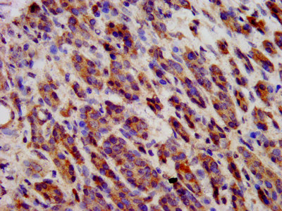 IHC image of CDH9 Antibody diluted at 1:600 and staining in paraffin-embedded human pancreatic cancer performed on a Leica BondTM system. After dewaxing and hydration, antigen retrieval was mediated by high pressure in a citrate buffer (pH 6.0). Section was blocked with 10% normal goat serum 30min at RT. Then primary antibody (1% BSA) was incubated at 4°C overnight. The primary is detected by a biotinylated secondary antibody and visualized using an HRP conjugated SP system.Rabbit anti-Human CDH9 Polyclonal Antibody