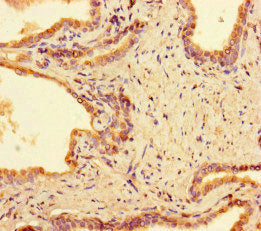 Immunohistochemistry of paraffin-embedded human prostate cancer using the antibody at dilution of 1:100Rabbit anti-Human PPM1H Polyclonal Antibody
