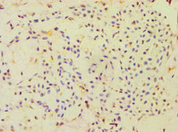 Immunohistochemistry of paraffin-embedded human breast cancer using CBLC Antibody at dilution of 1:100