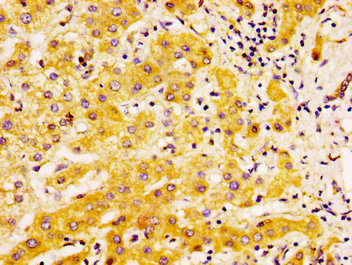 IHC image of EDAR Antibody diluted at 1:500 and staining in paraffin-embedded human liver cancer performed on a Leica BondTM system. After dewaxing and hydration, antigen retrieval was mediated by high pressure in a citrate buffer (pH 6.0). Section was blocked with 10% normal goat serum 30min at RT. Then primary antibody (1% BSA) was incubated at 4°C overnight. The primary is detected by a biotinylated secondary antibody and visualized using an HRP conjugated SP system.Rabbit anti-Human EDAR Polyclonal Antibody