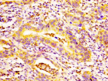IHC image of EDAR Antibody diluted at 1:500 and staining in paraffin-embedded human bladder cancer performed on a Leica BondTM system. After dewaxing and hydration, antigen retrieval was mediated by high pressure in a citrate buffer (pH 6.0). Section was blocked with 10% normal goat serum 30min at RT. Then primary antibody (1% BSA) was incubated at 4°C overnight. The primary is detected by a biotinylated secondary antibody and visualized using an HRP conjugated SP system.Rabbit anti-Human EDAR Polyclonal Antibody