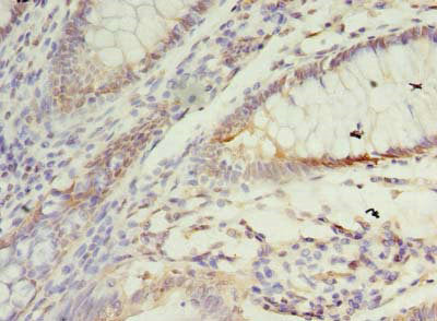 Immunohistochemistry of paraffin-embedded human colon cancer using SSR3 Antibody at dilution of 1:100Rabbit anti-Human SSR3 Polyclonal Antibody