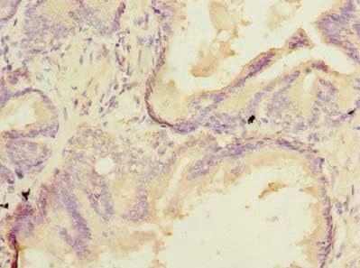 Immunohistochemistry of paraffin-embedded human prostate cancer using SSR3 Antibody at dilution of 1:100Rabbit anti-Human SSR3 Polyclonal Antibody