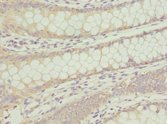 Immunohistochemistry of paraffin-embedded human colon cancer using the antibody at dilution of 1:100Rabbit anti-Human ANAPC2 Polyclonal Antibody