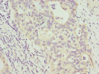 Immunohistochemistry of paraffin-embedded human bladder cancer using ANAPC2 Antibody at dilution of 1:100Rabbit anti-Human ANAPC2 Polyclonal Antibody
