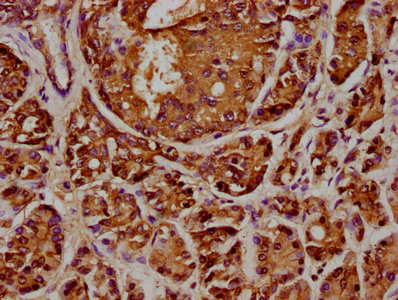 IHC image of ANAPC2 Antibody diluted at 1:348 and staining in paraffin-embedded human pancreatic cancer performed on a Leica BondTM system. After dewaxing and hydration, antigen retrieval was mediated by high pressure in a citrate buffer (pH 6.0). Section was blocked with 10% normal goat serum 30min at RT. Then primary antibody (1% BSA) was incubated at 4°C overnight. The primary is detected by a biotinylated secondary antibody and visualized using an HRP conjugated SP system.Rabbit anti-Human ANAPC2 Polyclonal Antibody