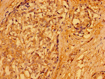 Immunohistochemistry of paraffin-embedded human breast cancer using PACSIN3 Antibody at dilution of 1:100Rabbit anti-Human PACSIN3 Polyclonal Antibody