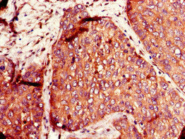 Immunohistochemistry of paraffin-embedded human ovarian cancer using the antibody at dilution of 1:100Rabbit anti-Human SLC12A7 Polyclonal Antibody
