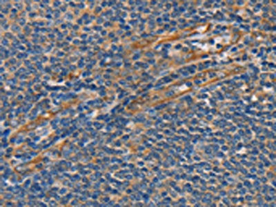 The image on the left is immunohistochemistry of paraffin-embedded Human tonsil tissue using SLC39A7 Antibody(SLC39A7 Antibody) at dilution 1/25, on the right is treated with synthetic peptide. (Original magnification: ×200)Rabbit anti-Human SLC39A7 Polyclonal Antibody