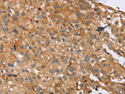 The image on the left is immunohistochemistry of paraffin-embedded Human liver cancer tissue using the antibody Antibody) at dilution 1/25, on the right is treated with synthetic peptide. (Original magnification: ×200)Rabbit anti-Human SLC39A7 Polyclonal Antibody