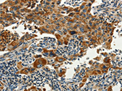 The image on the left is immunohistochemistry of paraffin-embedded Human lung cancer tissue using SERPINA9 Antibody(SERPINA9 Antibody) at dilution 1/60, on the right is treated with synthetic peptide. (Original magnification: ×200)Rabbit anti-Human SERPINA9 Polyclonal Antibody