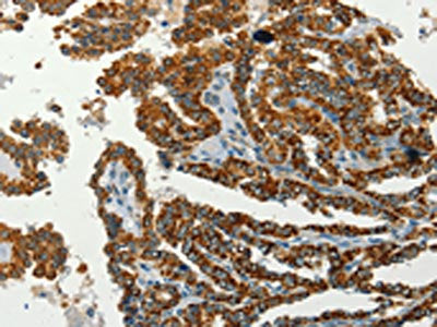 The image on the left is immunohistochemistry of paraffin-embedded Human thyroid cancer tissue using the antibody Antibody) at dilution 1/60, on the right is treated with synthetic peptide. (Original magnification: ×200)Rabbit anti-Human SERPINA9 Polyclonal Antibody