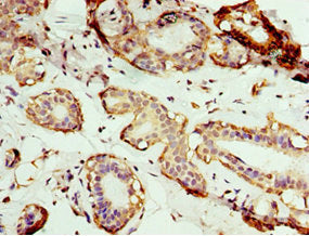 Immunohistochemistry of paraffin-embedded human breast cancer using AP1M2 Antibody at dilution of 1:100Rabbit anti-Human AP1M2 Polyclonal Antibody