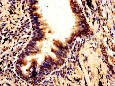 IHC image of RUVBL1 Antibody diluted at 1:600 and staining in paraffin-embedded human lung cancer performed on a Leica BondTM system. After dewaxing and hydration, antigen retrieval was mediated by high pressure in a citrate buffer (pH 6.0). Section was blocked with 10% normal goat serum 30min at RT. Then primary antibody (1% BSA) was incubated at 4°C overnight. The primary is detected by a biotinylated secondary antibody and visualized using an HRP conjugated SP system.Rabbit anti-Human RUVBL1 Polyclonal Antibody